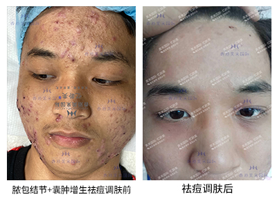 祛痘案例-美膚來（深圳）生物科技有限公司